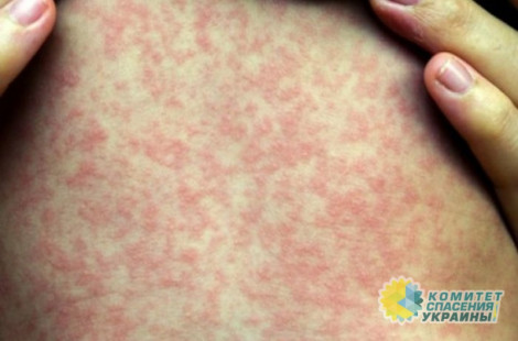 За неделю корью на Украине заболело более 1,3 тыс. человек