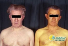 В Николаеве вспышка гепатита А